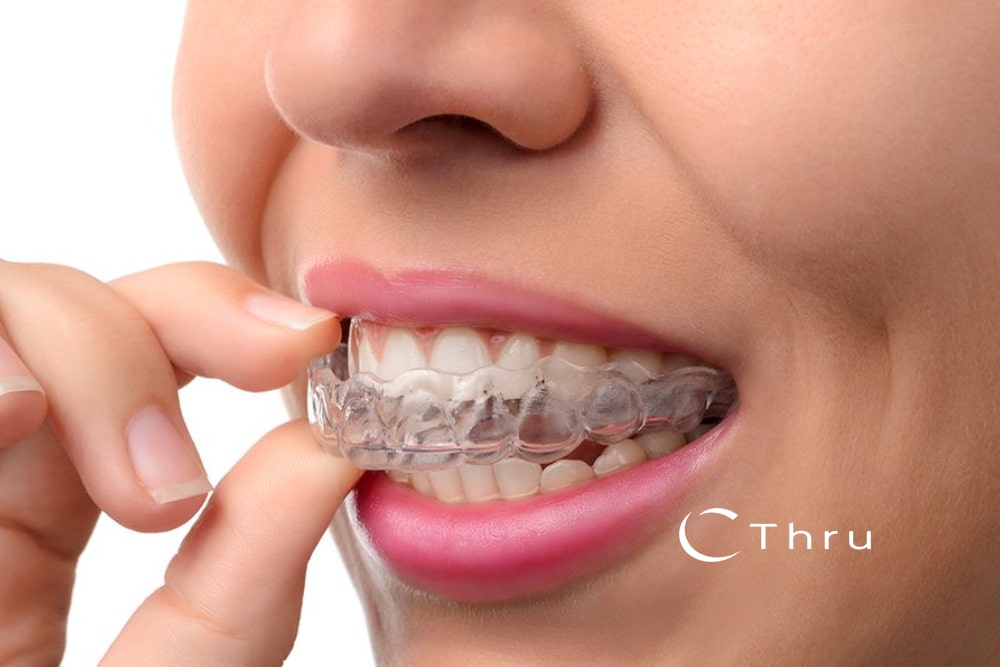 Tooth Straightening 1 teeth straigtening c thru logo southfield dental