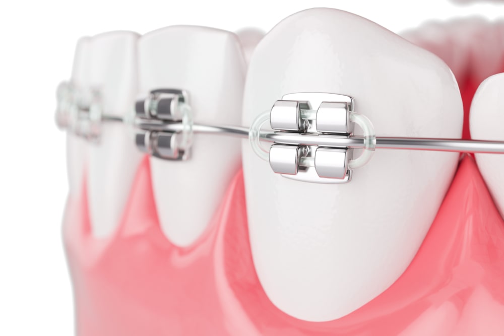 Tooth Straightening 2 southfield dental cosmetic dentistry tooth straightening