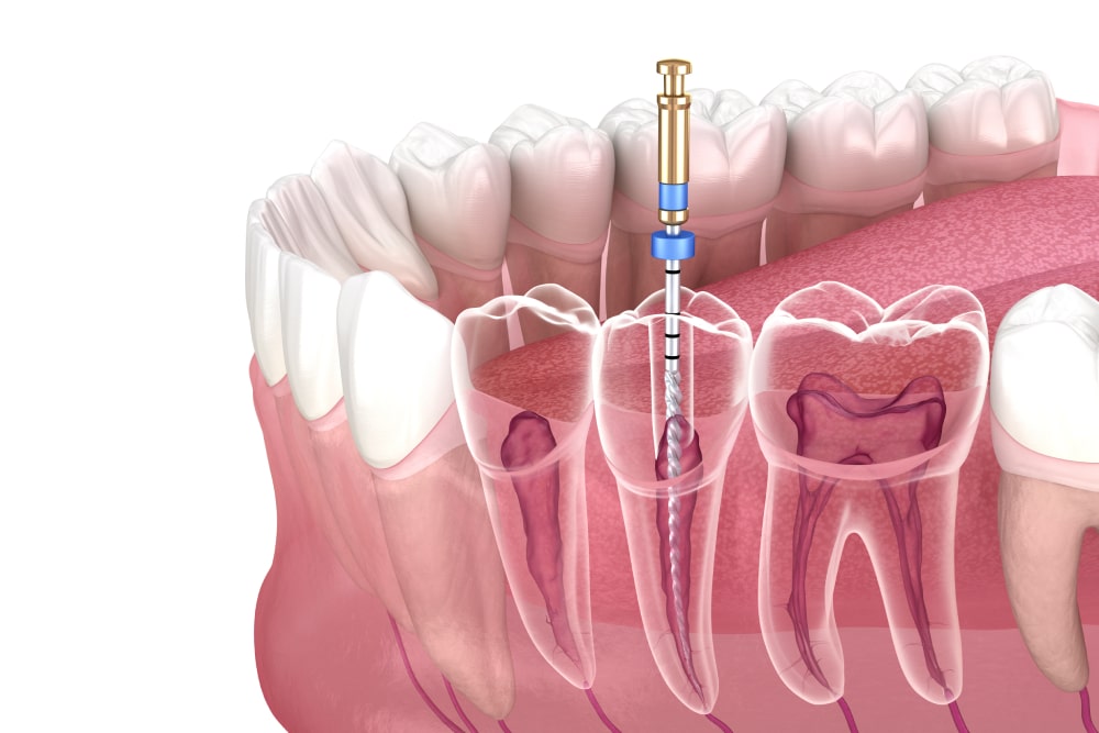 Root Fillings 2 southfield dental root fillings follow up