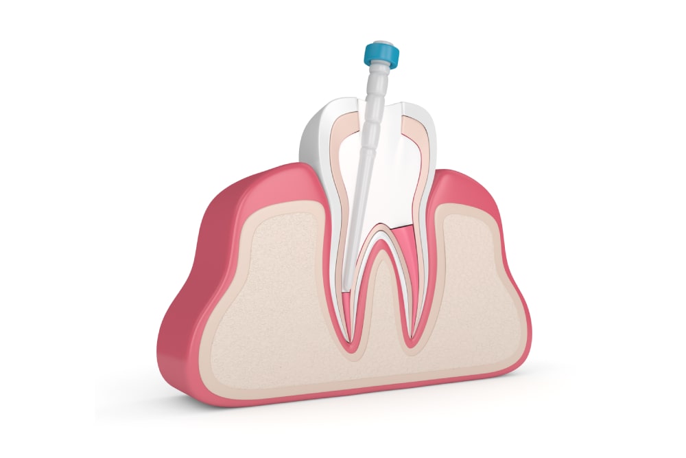 Root Fillings 1 southfield dental root fillings treatment preparation
